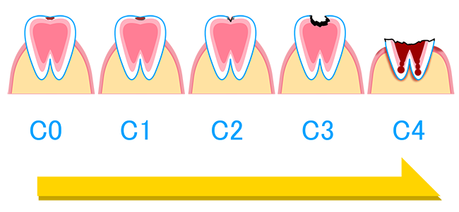 吉田歯科医院・虫歯の進行