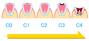 吉田歯科医院・虫歯の進行
